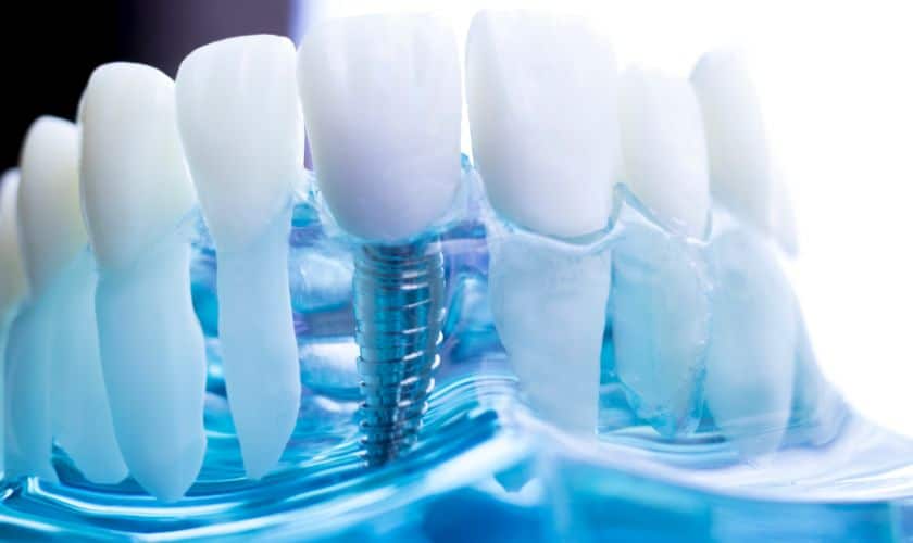Dental Implants And Smoking — Everything You Need To Know
