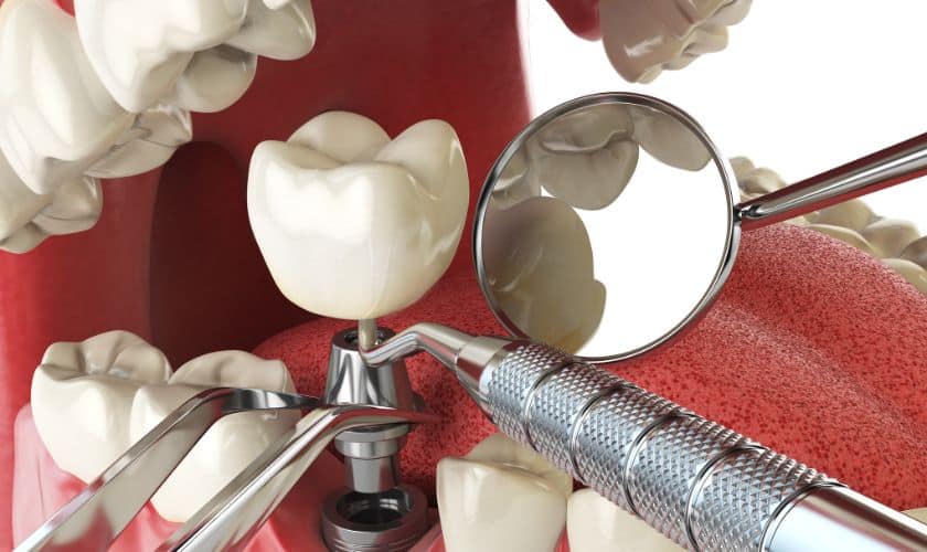 New Year, New Smile: Embracing 5 Innovative Trends in Dental Implants for 2024