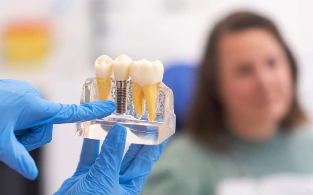 The Step-by-Step Process of Getting Dental Implants